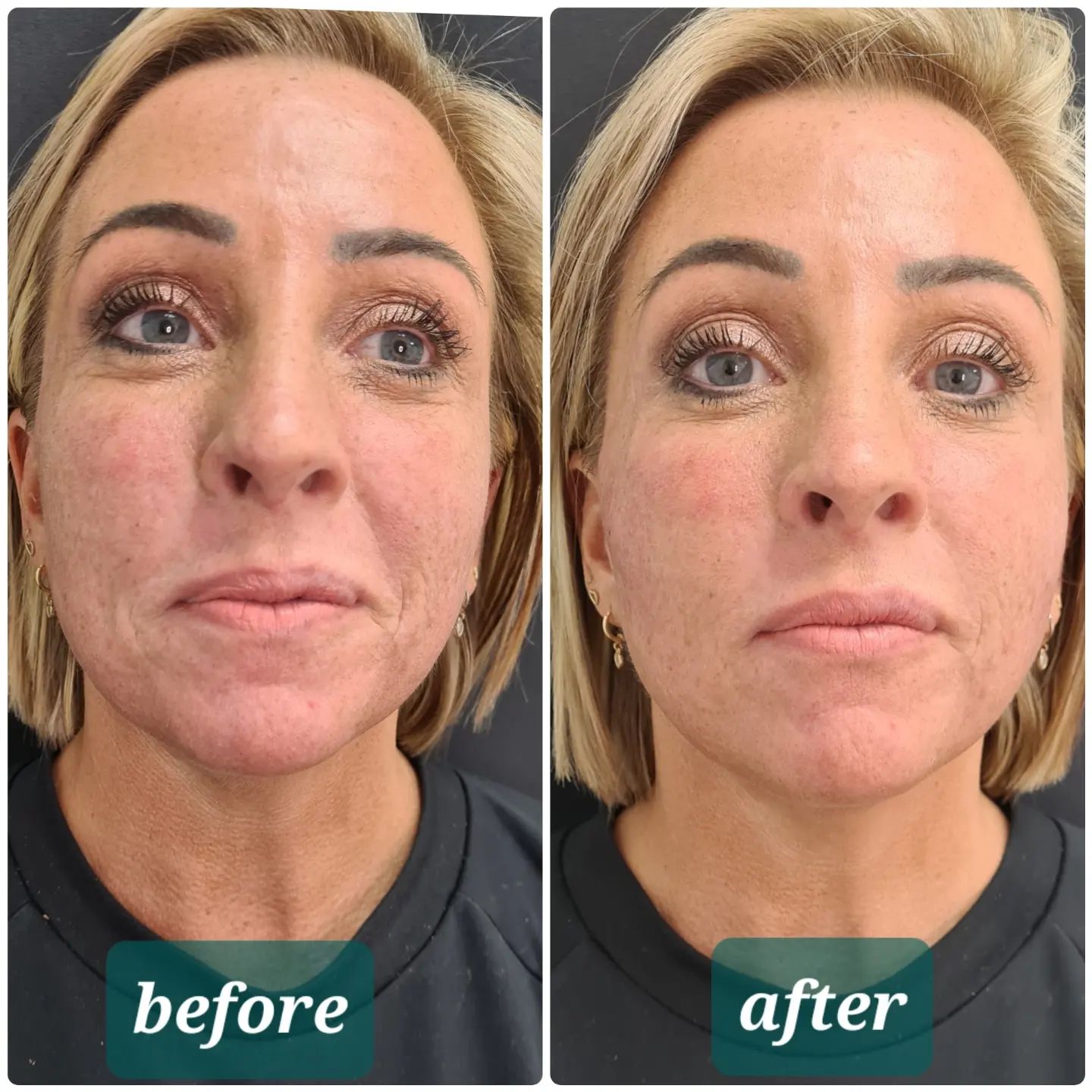 HArmonyCa from Needle Nurse Aesthetics in Washington